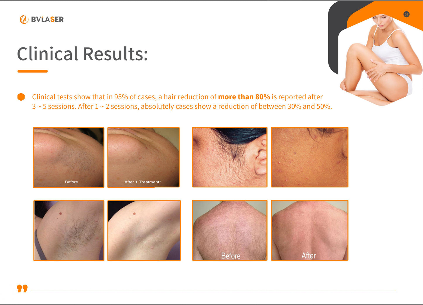 BV Laser – 4 Wavelength Diode Laser Hair Removal Machine (FDA Approved)